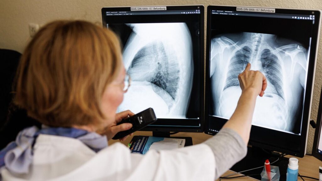 La respuesta del cuerpo a diferentes cepas de tuberculosis podría afectar a la transmisión, según un estudio